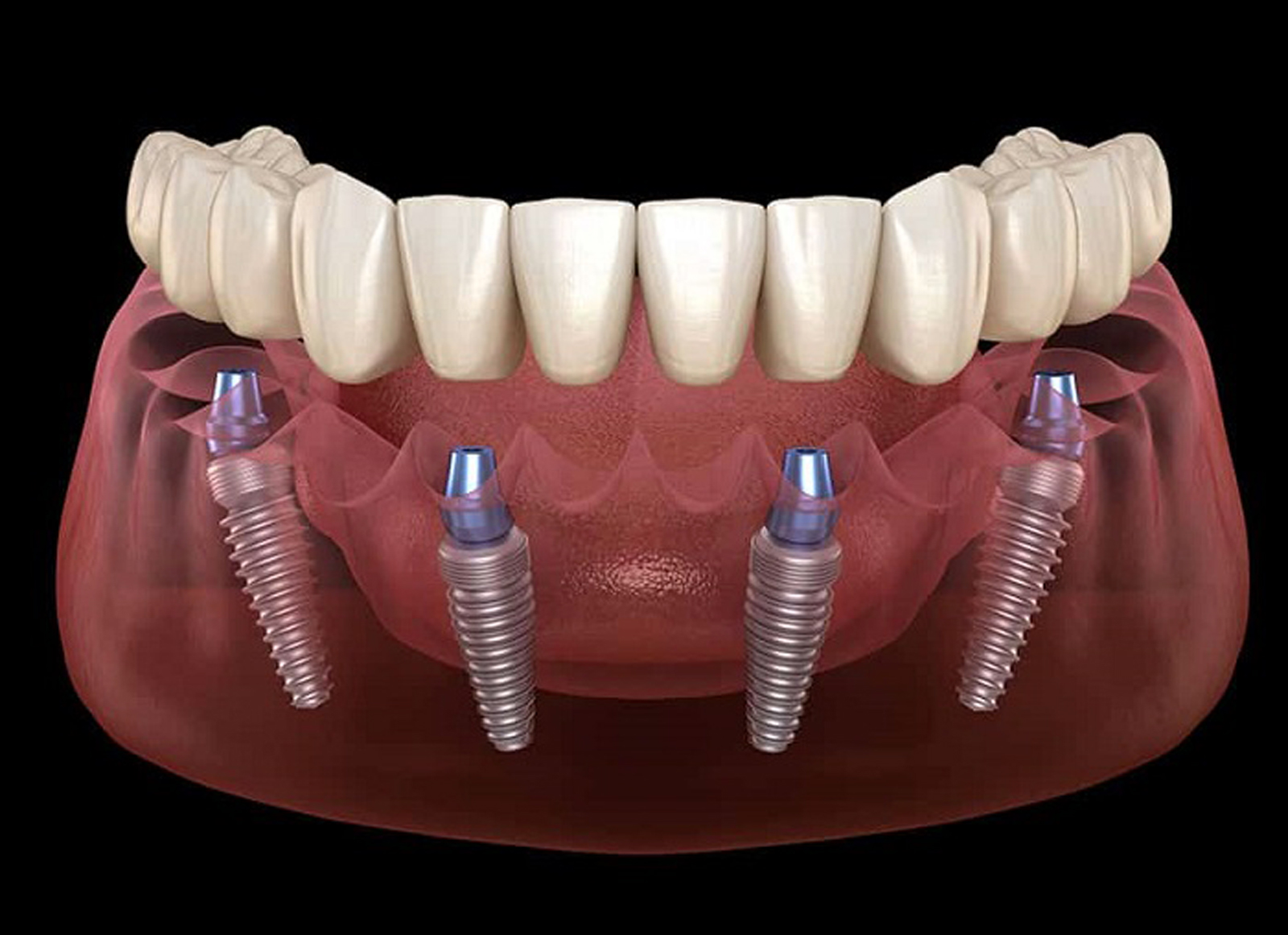 Implantes All-on-4