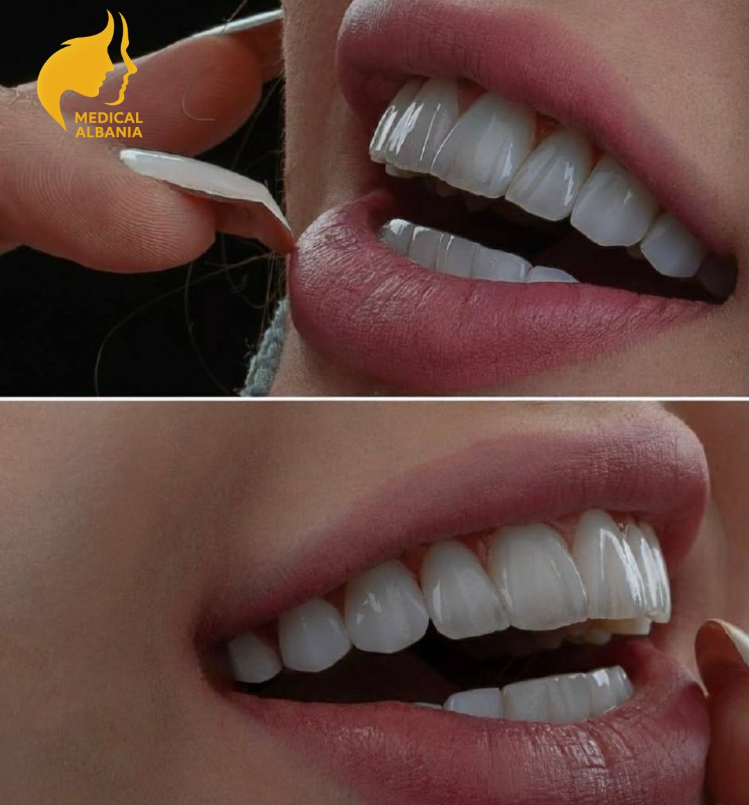 Antes y Despues - Carillas Dentales