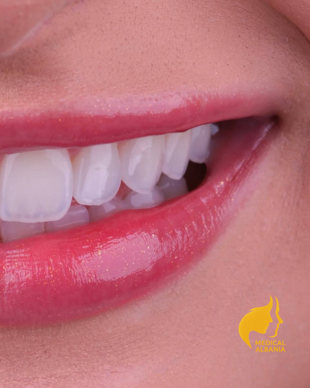 Vorher und Nachher - Perfektes Lächeln