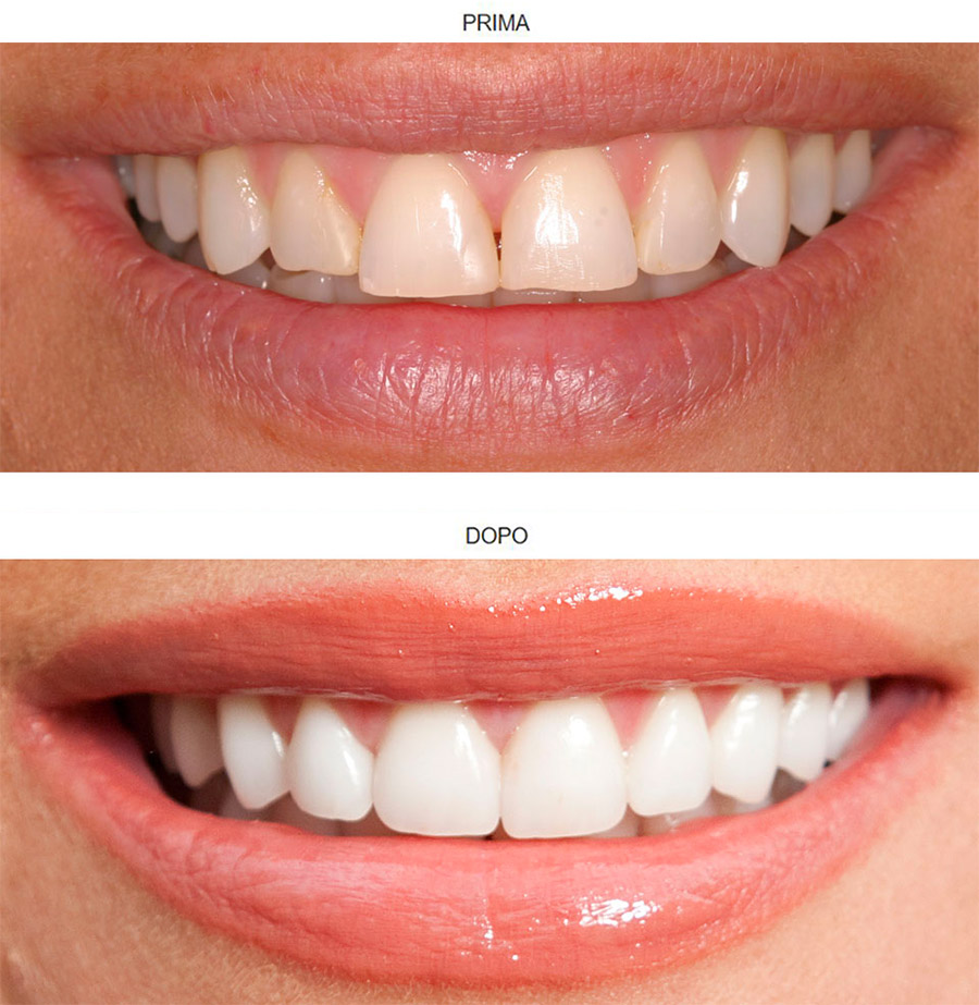 Antes y Despues - Blanqueamiento